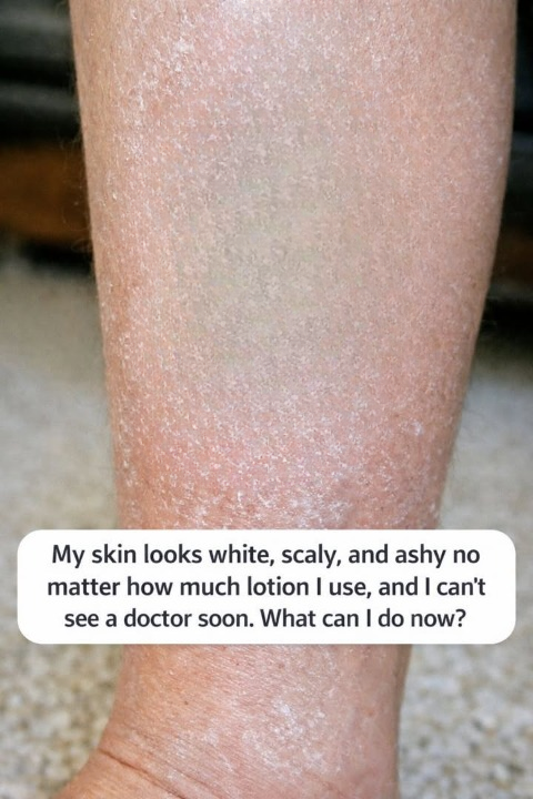Why Does Skin Sometimes Stay Dry, White, or Ashy Even After Using Lotion? Practical Tips That May Help Until You Can See a Healthcare Professional