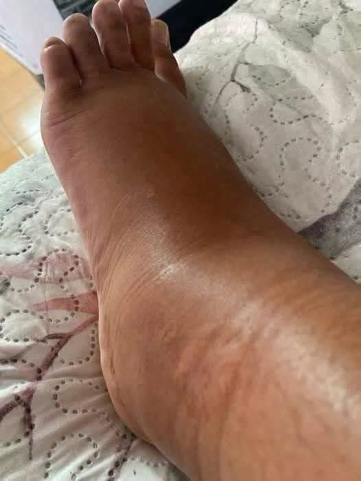 Unlocking the Mystery: What Your Swollen Feet Are Desperately Trying to Tell You