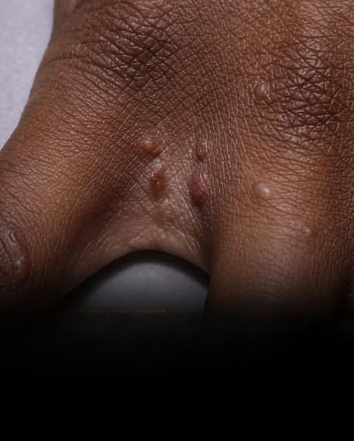Small Red Bumps on the Skin: Understanding What They May Mean and When They Deserve Attention