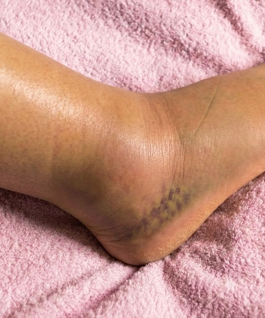 If You Notice Your Legs or Ankles Becoming Swollen, Don’t Ignore the Change: Common Causes, Important Warning Signs, and When to Seek Medical Advice