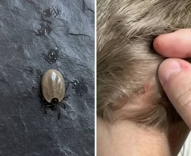 Does Anyone Know What Kind of Bug This Could Be? A Parent Spotted an Unusual Insect on Their Child’s Scalp and Quickly Started Looking for Answers