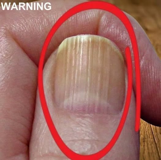 Noticing Lines or Ridges on Your Fingernails? Here’s What Those Changes Can Sometimes Mean, What May Cause Them, and When It’s Worth Paying Attention
